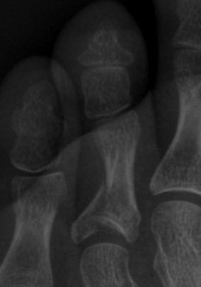 그림 1. 제 4 발가락 근위지골의 관절을 침범한 골절