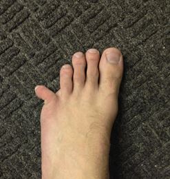 그림 2. 발가락 골절을 의심할 수 있는 부종과 멍 혹은 변형 