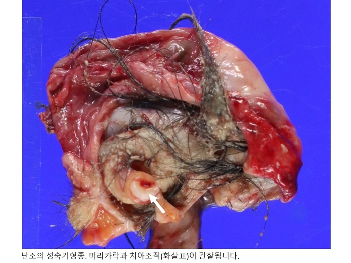 난소의 성숙기형종
