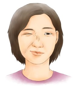 반얼굴연축: 얼굴 측면 근육이 간헐적으로 수축함