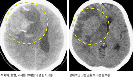 뇌 CT 영상