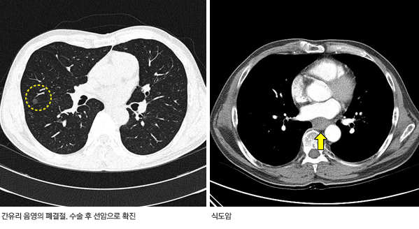 저선량 CT(좌) 및 흉부 CT(우) 영상