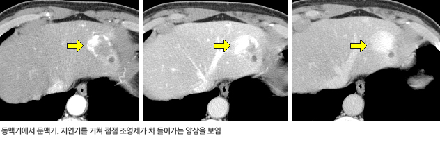 동맥기에서 문맥기, 지연기에서 점점 조영제가 차 들어가는 양상을 보임