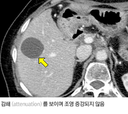 전형적인 간의 단순낭종 CT 영상