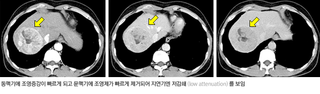 전형적인 간세포암 CT 영상