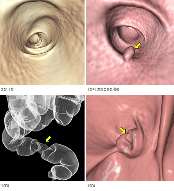 CT 대장조영술 영상