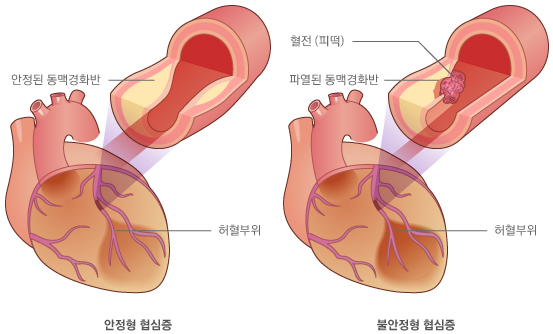 협심증 모식도