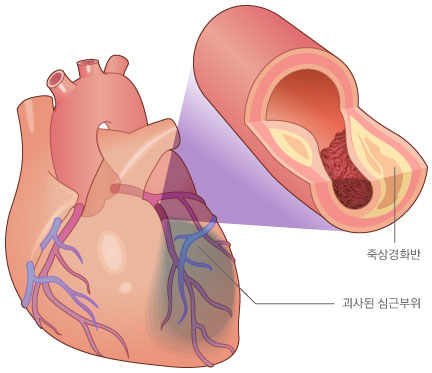 심근경색증 모식도