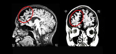 이마관자엽 치매 환자의 MRI. 전두엽이 위축이 두드러짐.