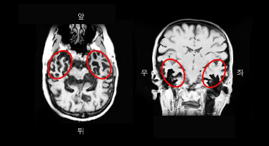 의미 치매 환자의 MRI. 측두엽의 위축이 두드러짐.