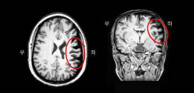 진행성 비유창성 실어증 환자의 MRI. 브로카영역의 위축이 두드러짐.