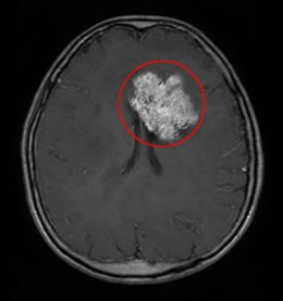 교모세포종의 MRI 소견