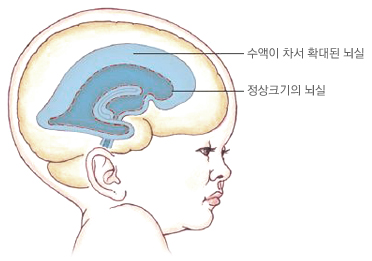 수두증