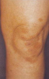 다형홍반의 특징적인 과녁모양 병변