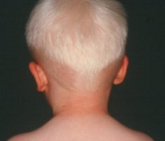 눈 피부 백색증에서 머리카락의 색소가 감소한 모습