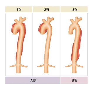 대동맥박리 유형별 분류 (드베키 분류법, 스탠포드 분류법)
