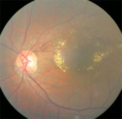 망막분지 정맥 폐쇄