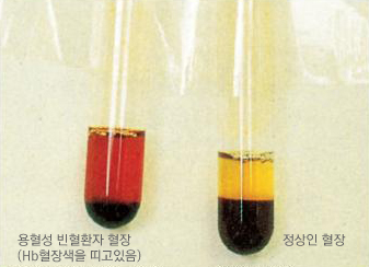 용혈성 빈혈의 혈액검사