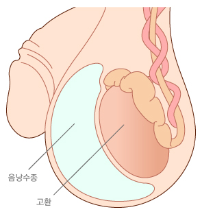 음낭수종의 구조
