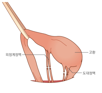 정계정맥류 교정술