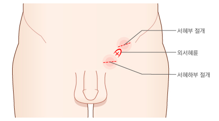 서혜부 및 서혜하부 접근법