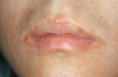 입술 주위에 생긴 두드러기