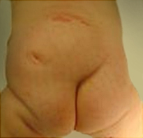 소아의 지방 척수 수막류 증상