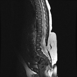 지방 척수 수막류 MRI