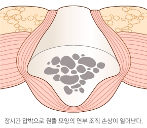 압박궤양의 손상 양상