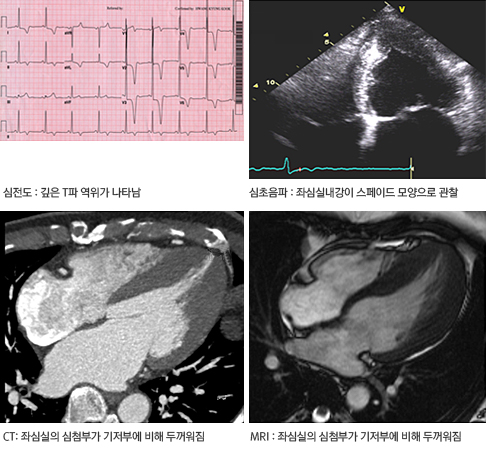 심첨부 비후성 심근증 검사