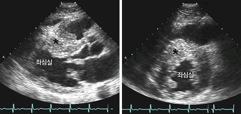 심실중격 비후성 심근증의 심초음파: 심실중격(*)이 좌심실 후벽에 비해 두꺼워져 있음