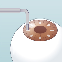 주파 각막 성형술