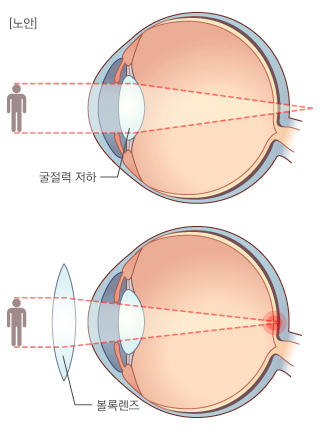 볼록렌즈로 노안 교정