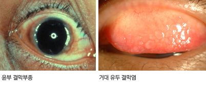 알레르기 결막염 증상