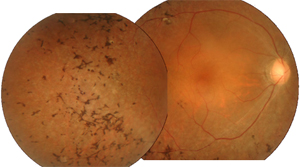 망막색소변성 안저 사진
