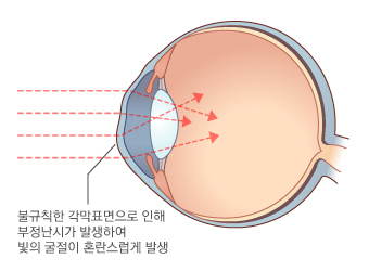원추각막의 비정상적인 빛의 굴절