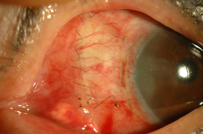 익상편 제거 및 자가결막 이식을 시행한 직후 모습