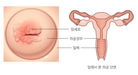 자궁경부암