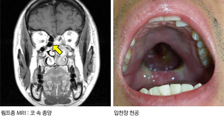림프종 양상