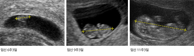 임신 초기 초음파 영상