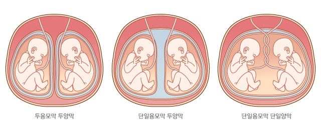 일란성 쌍둥이의 종류