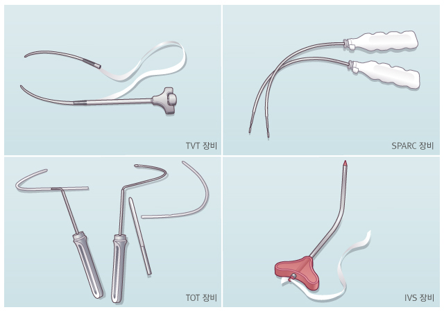 요실금 시술 장비