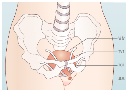 TVT와 TOT 후 테이프의 위치