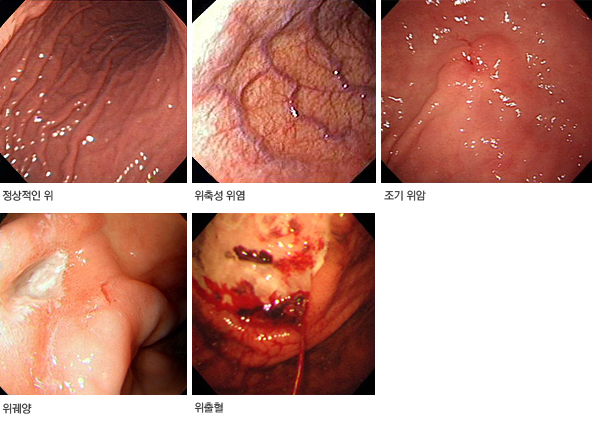 위내시경 검사 사진