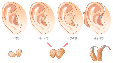 보청기의 종류