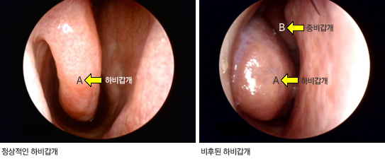비강 앞에서 바라본 내시경 사진