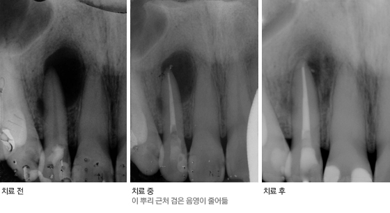 신경치료 전과 후