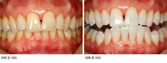 미백 전과 후