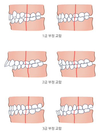 부정 교합의 종류
