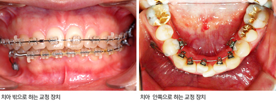 교정 치료